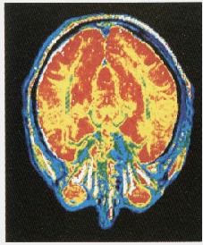 Πυρηνική Μαγνητική Τομογραφία του εγκεφάλου